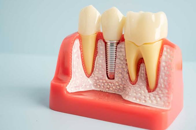 Dental Implants